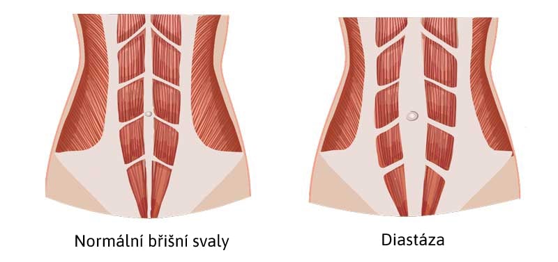 Normální břišní svaly vlevo a vpravo diastáza