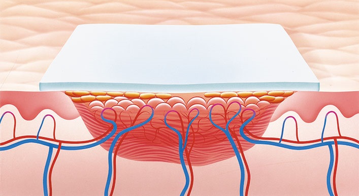 Rolle des Wundverbandes in der Epithelisierungsphase