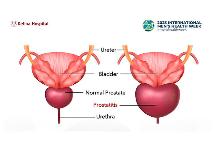 Inflamación de la próstata. Prostatitis en hombres